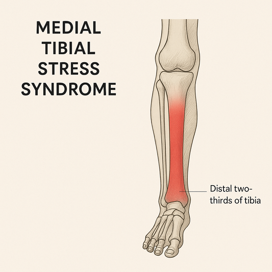 Shin splints: what they are and how to manage them