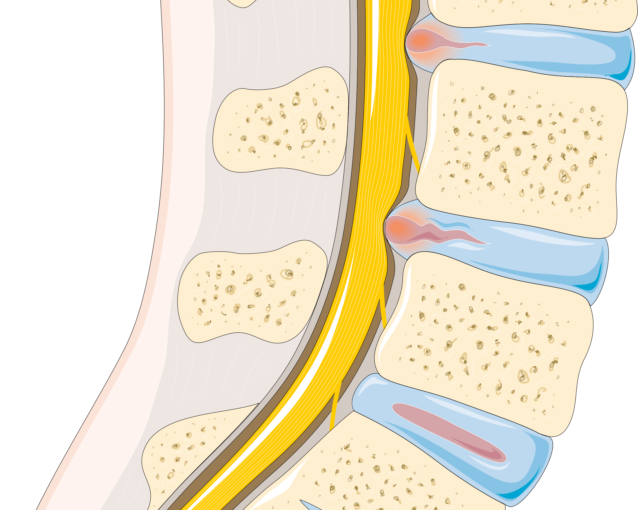 File:Disc_herniation_--_Smart-Servier.png