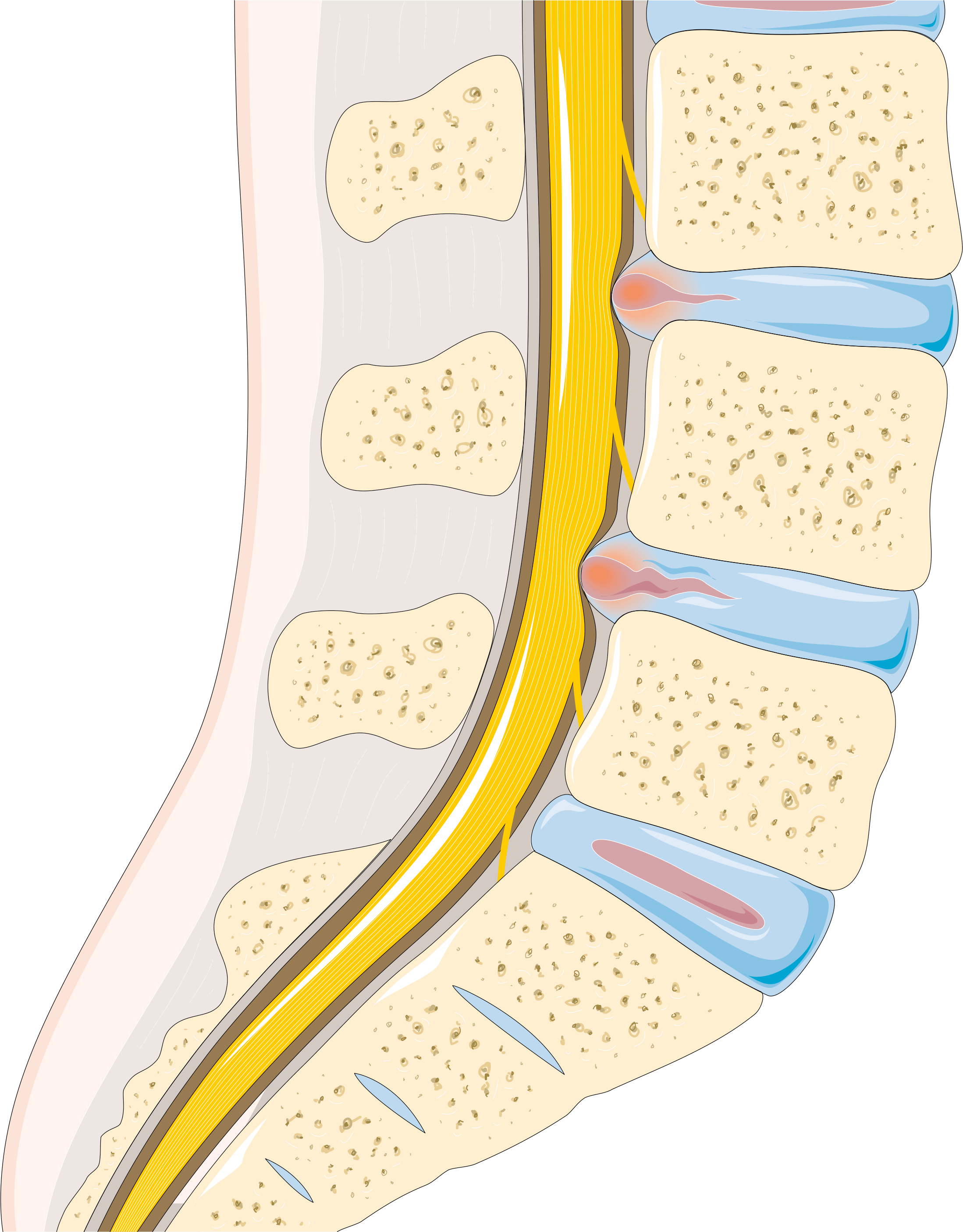 File:Disc_herniation_--_Smart-Servier.png