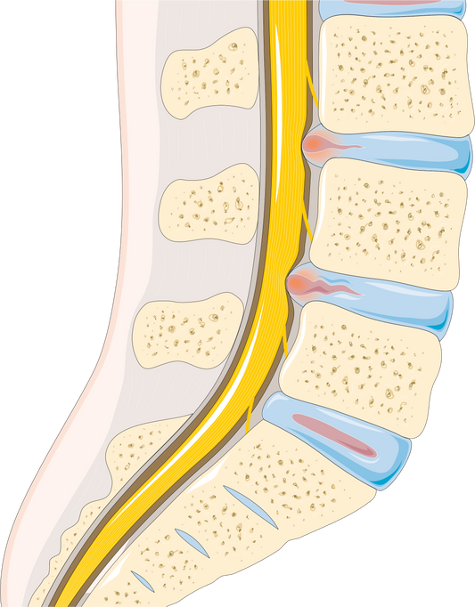 https://commons.wikimedia.org/wiki/File:Disc_herniation_--_Smart-Servier.png