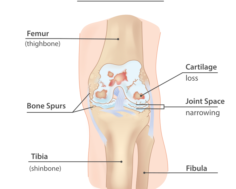 Osteoarthritis: an exemplar of why hurt doesn’t mean harm