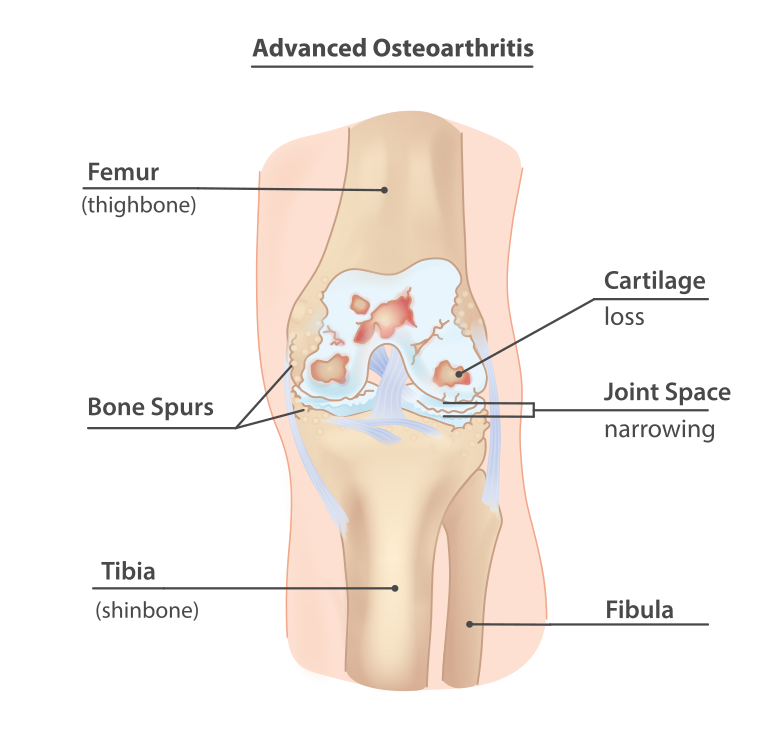 Osteoarthritis: an exemplar of why hurt doesn’t mean harm