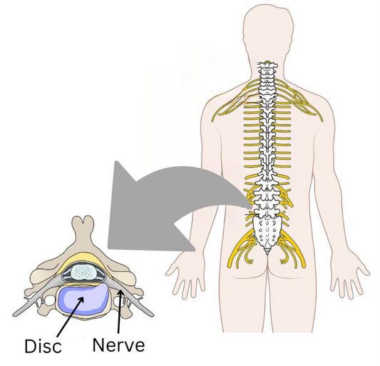 Sciatica: what is it and do you need surgery?